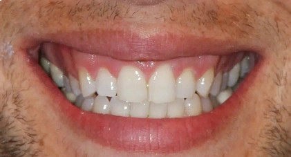 Dental Fillings in Tribeca